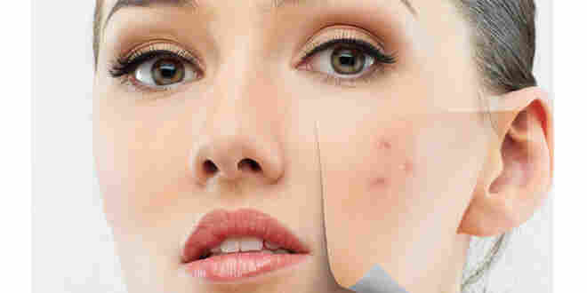 Sivilcelere Önceden Önlem Alabilirsiniz