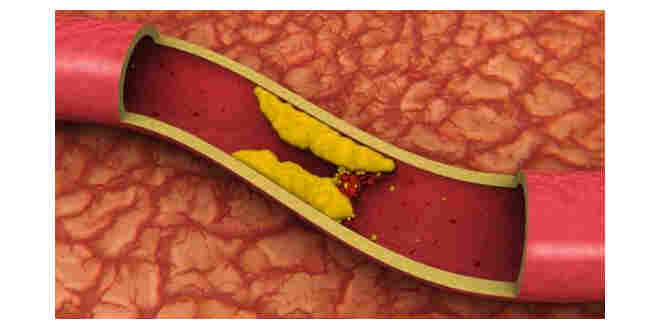 Yüksek Kolesterol Kalp Ve Damar Hastaığı Nedeni